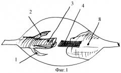Способ пластики ахиллова сухожилия (патент 2340301)