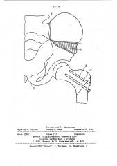 Способ лечения врожденного вывиха бедра (патент 931176)