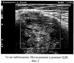 Способ ультразвуковой диагностики рецидивов мягкотканых сарком и фиброзных изменений (патент 2311129)