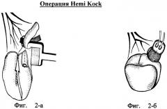 Способ инвертирующей ортотопической илеоцистопластики при короткой брыжейке подвздошной кишки (патент 2371102)