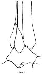Способ репозиции наружной лодыжки при оперативном лечении застарелых повреждений голеностопного сустава (патент 2403881)