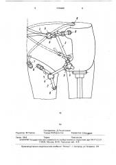 Крепление протезов после вычленения бедра (патент 1736480)