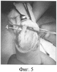 Способ лечения сгибательной контрактуры лучезапястного сустава от 90° и более у больных с артрогрипозом (патент 2373885)