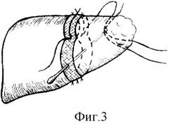 Способ резекции печени (патент 2278617)