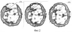 Способ проведения однофотонной эмиссионной компьютерной томографии головного мозга в диагностике и определении степени злокачественности глиальных опухолей (патент 2375961)