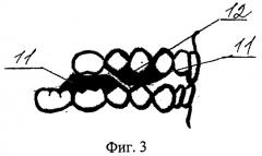 Аппарат для лечения гнатической формы мезиальной окклюзии у подростков (патент 2547789)