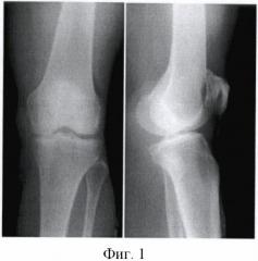 Способ лечения ранних стадий остеоартроза коленного сустава (патент 2367447)