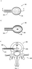 Способ формования криогелей поливинилового спирта (патент 2561120)