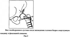 Способ хирургического лечения вывиха бедра у детей (патент 2502486)