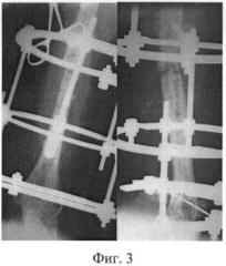 Способ лечения несросшихся переломов и ложных суставов длинных костей (патент 2383309)