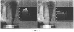 Метод использования рентгеноморфометрии для оценки минеральной плотности костной ткани альвеолярной кости (патент 2320267)