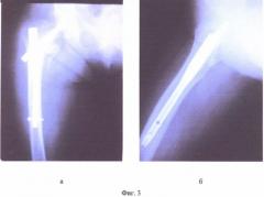 Способ лечения переломов проксимального отдела бедра в условиях остеопороза (патент 2473317)