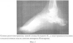 Способ устранения посттравматического плоскостопия (патент 2413474)