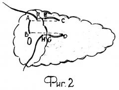 Способ формирования культи поджелудочной железы при наложении панкреатоеюноанастомоза (патент 2256413)
