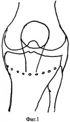 Способ лечения гонартроза, сопровождающегося осевыми деформациями нижней конечности (патент 2545917)