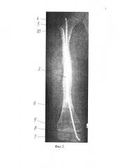 Способ комбинированного остеосинтеза длинных трубчатых костей при коррекции деформации у детей с несовершенным остеогенезом (патент 2615279)