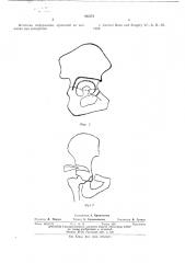 Способ ацетабулопластики при подвывихе бедра (патент 562272)