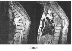 Способ диагностики натечных абсцессов при туберкулезном спондилите на низкопольном магнитно-резонансном томографе (патент 2255653)