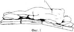 Способ хирургического лечения грыжи грудного межпозвонкового диска (патент 2311146)