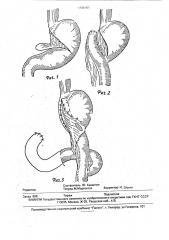 Способ резекции желудка (патент 1796161)