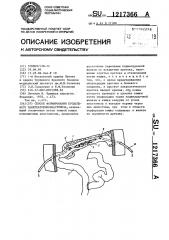 Способ формирования продольного панкреатоеюноанастомоза (патент 1217366)