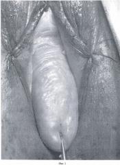 Способ хирургического лечения изолированного неполного или полного выпадения шейки матки (патент 2476174)