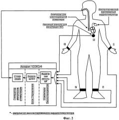 Электрокардиостимулятор (патент 2531695)