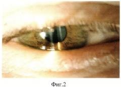 Способ определения степени блефароконъюнктивальной формы синдрома сухого глаза (патент 2500340)