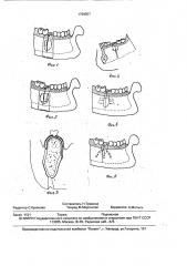 Способ хирургического лечения остеомиелитов нижней челюсти (патент 1799557)