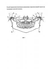 Метод определения инклинации мыщелкового отростка нижней челюсти на томограммах челюстей (патент 2633330)