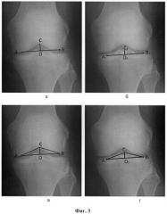 Скрининговая рентгенометрическая диагностика дисплазии мыщелков коленного сустава (патент 2381744)