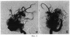 Способ эмболизации церебральных артериовенозных мальформаций (патент 2497457)