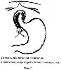 Способ пластики грыжи пищеводного отверстия диафрагмы (патент 2261663)