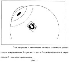 Способ лечения регматогенной отслойки сетчатки (патент 2244530)