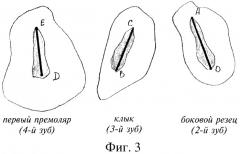 Способ прогнозирования ортодонтической коррекции ретенции верхних постоянных клыков (патент 2269968)