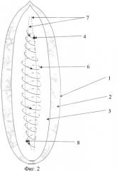Способ устранения послеоперационных рецидивных многокамерных вентральных грыж брюшной стенки (патент 2408318)