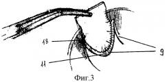 Способ протезирования створок аортального клапана и шаблоны для его осуществления (патент 2314041)
