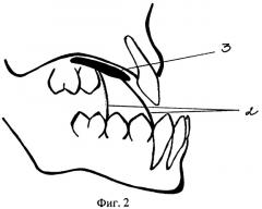 Ортодонтическое устройство (патент 2275882)