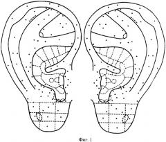 Способ определения функционального состояния больных по порогу чувствительности точек акупунктуры на ушной раковине (патент 2303395)