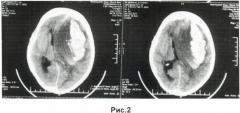 Способ определения характера нетравматического внутримозгового кровоизлияния (патент 2487661)
