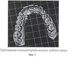 Способ воспроизведения зарегистрированных окклюзионных положений на компьютерных трехмерных моделях зубных рядов и ориентации компьютерных трехмерных моделей в пространстве (патент 2401083)