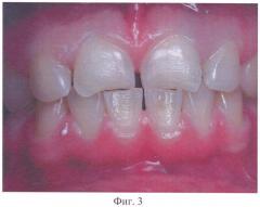 Способ восстановления коронковой части зубов, относящихся к группе резцов (патент 2441619)