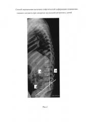 Способ определения величины кифотической деформации позвоночно-тазового сегмента при синдроме каудальной регрессии у детей (патент 2604041)