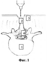 Способ реконструкции позвоночного канала при опухоли спинного мозга (патент 2567824)