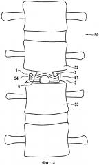 Межпозвонковый соединительный имплантат (патент 2633474)