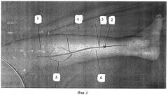 Способ кожной пластики дефектов покровных тканей дистального отдела нижней конечности (патент 2391062)