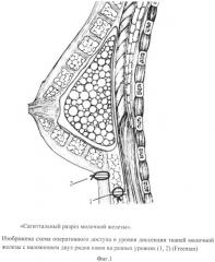 Способ инфрамаммарного доступа при кожесохраняющей мастэктомии с одномоментной реконструкцией силиконовым имплантатом (патент 2545431)