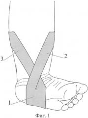 Способ консервативного лечения врожденной плоско-вальгусной деформации стоп (патент 2368356)