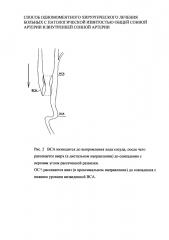 Способ одномоментного хирургического лечения больных с патологической извитостью общей сонной артерии и внутренней сонной артерии (патент 2618209)