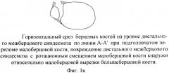 Способ оперативного лечения подголовчатых переломов малоберцовой кости при переломовывихах в голеностопном суставе (патент 2369341)